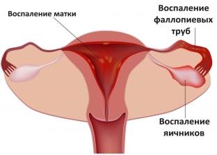 Эндометрит – Причины, симптомы, диагностика и лечение